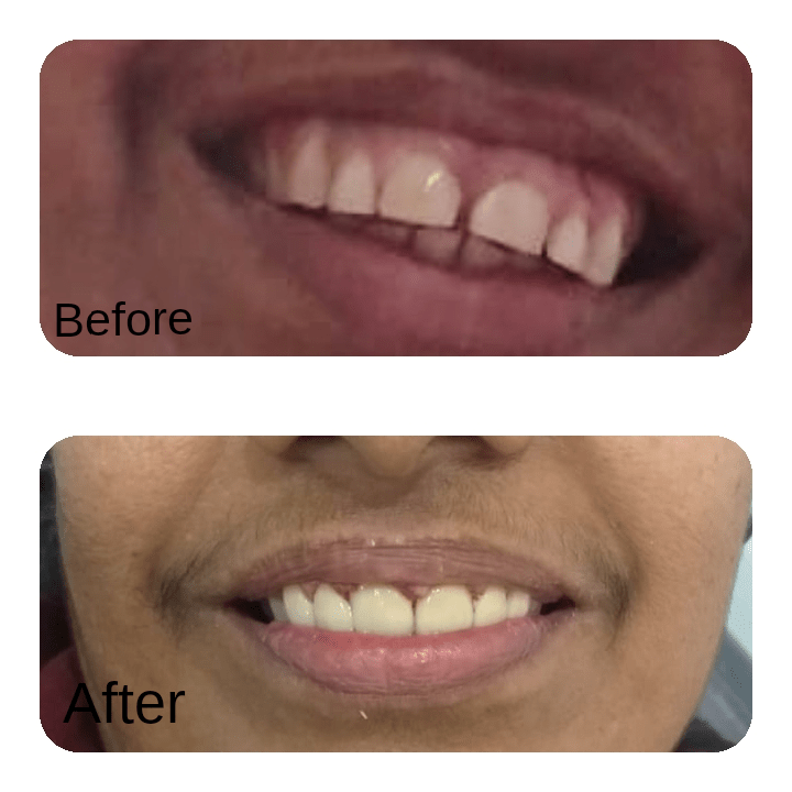 Veneers - Before and after