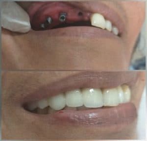 One of our happy patient who has undergone implant treatment in our clinic Dental Implants Vs Dentures