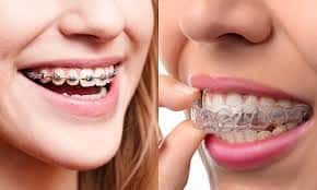 clear-aligner-vs-braces