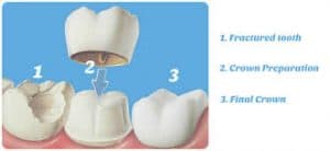 Crown Over Root Canal Treated Teeth Crown Over Root Canal Treated Teeth
