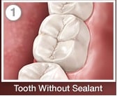 Tooth Without Sealant